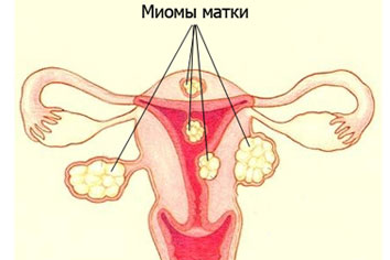 Причины миомы матки