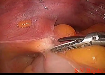 Laparoscopic radical hysterectomy Piver II